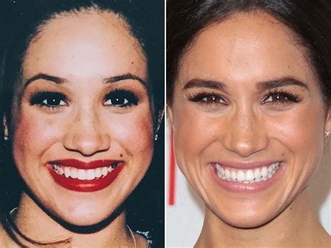 Find Out Why Meghan Markles Nose Is A Plastic Surgery Trend!